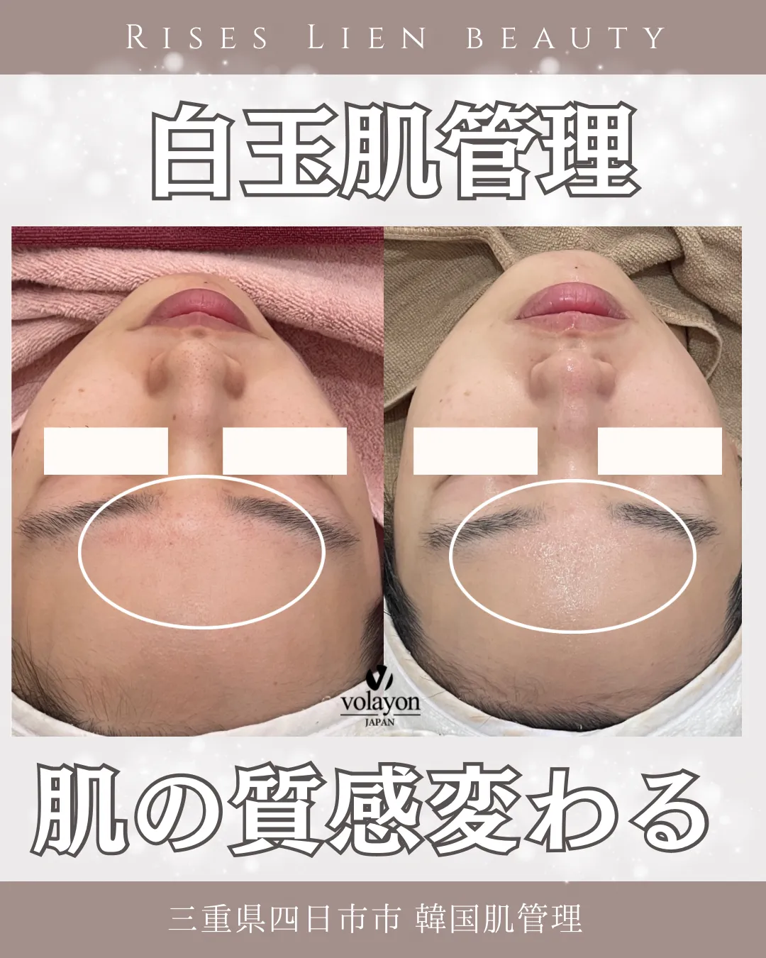 白玉肌管理【BeforeAfter】赤みレス圧倒的透明感!三重県四日市市