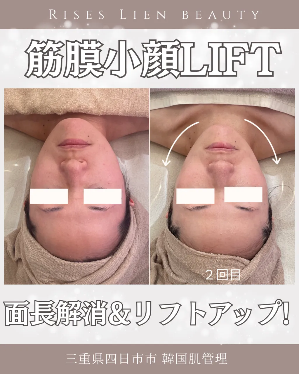 美しいⅤラインフェイスを叶える魔法の小顔矯正【BeforeAfter】三重県四日市・エステ