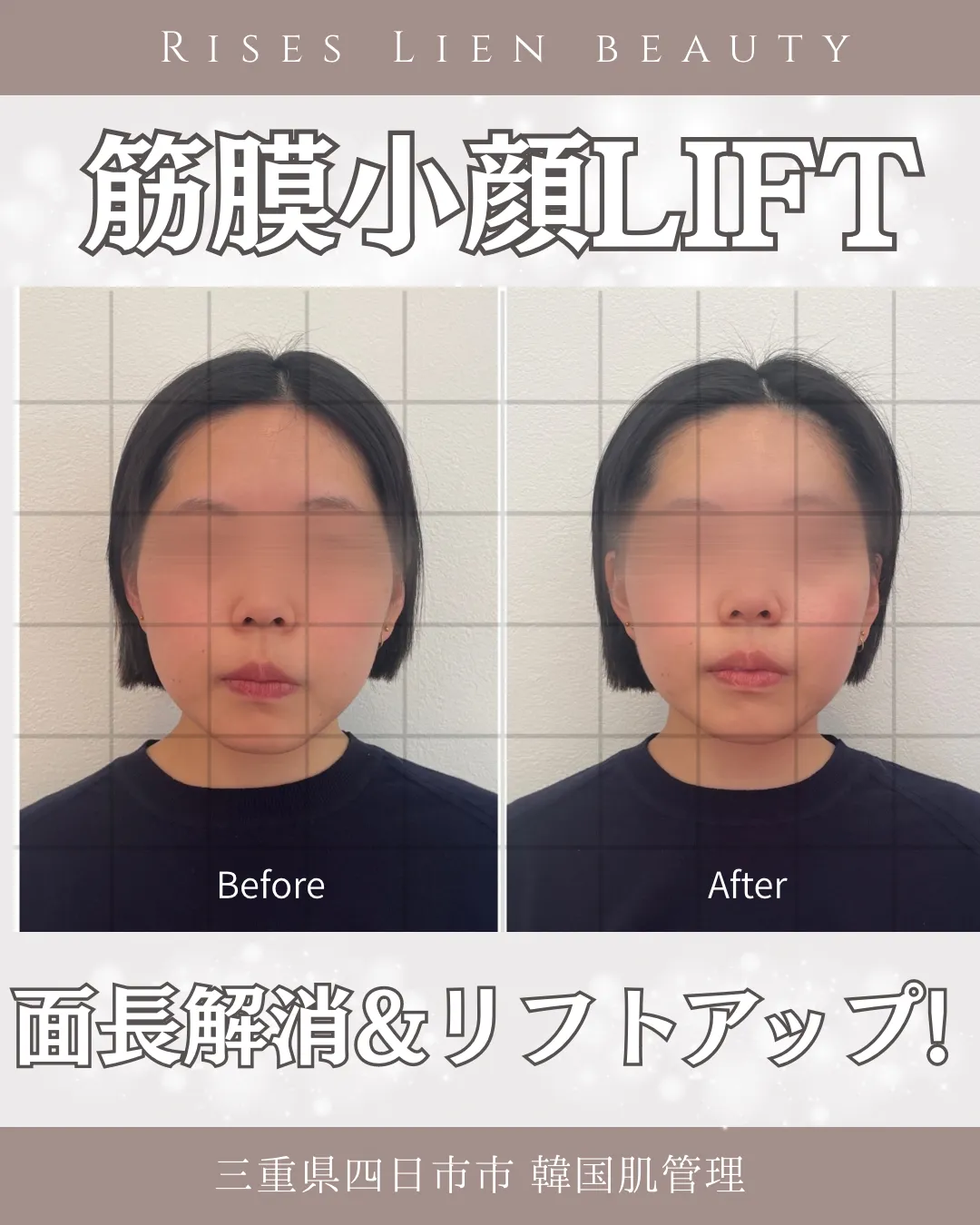 顔の余白なかったことに!魔法の小顔矯正【BeforeAfter】三重県四日市・小顔エステ