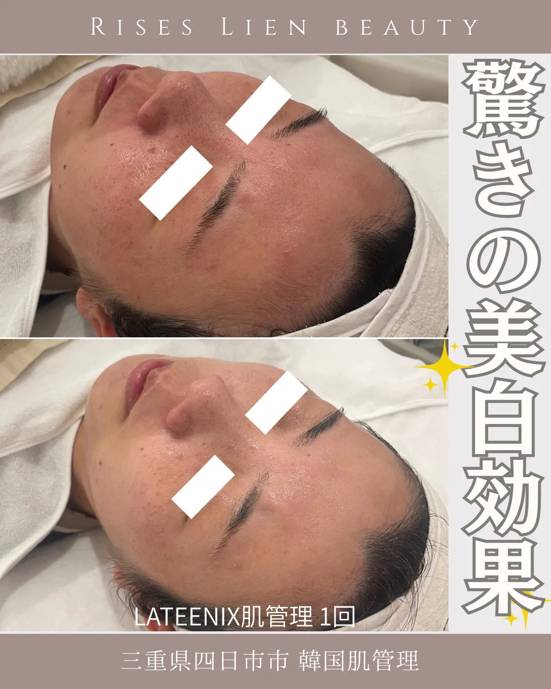 くすみ改善【BeforeAfter】三重県四日市市・韓国肌管理